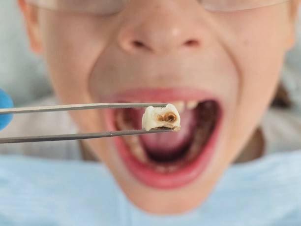 Best Broken Tooth Emergency  in Parma, ID